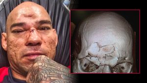 MMA: gli infortuni peggiori della storia Il bruttissimo infortunio di Cyborg Santos contro MVP