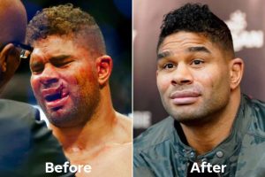 MMA: gli infortuni peggiori della storia Il labbro di Overeem prima e dopo l'incontro contro Jairzinho